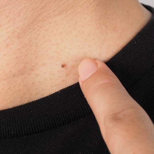 What is a Verruca and How Can You Identify it?